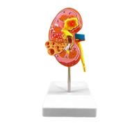 Modèle d'anatomie 4D Modèle d'anatomie du Rein Humain Modèle d'enseignement Organes Humains Modèle de Rein Malade Modèle de Corps Humain Modèle de Rein Éducation Éduquer