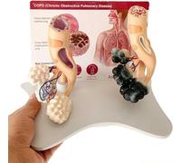 Modèle D'anatomie Alvéolaire: Différence Tabagisme/autres Méthodes