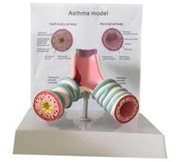 Modèle d'anatomie de l'asthme humain,modèle bronchique du système respiratoire