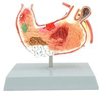 Modèle D'anatomie De L'estomac Humain for L'éducation Et L'apprentissage | Modèle détaillé de pathologie gastrique for les passionnés d'anatomie et les étudiants.