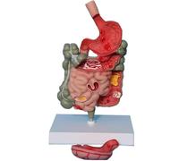 Modèle d'anatomie de l'estomac humain, modèle de pathologie de l'intestin, modèle du système digestif pathologique, modèle d'enseignement amovible, section de l'estomac, modèle médical