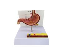 Modèle d'anatomie de l'estomac pathologique - Perforation gastrique anatomique - Outil d'enseignement en classe pour l'anatomie clinique