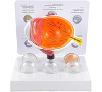 Modèle d'anatomie de l'œil Humain avec Carte explicative, présentant 5 Conditions pathologiques, Outil éducatif détaillé pour l'apprentissage des Sciences et l'étude des étudiants