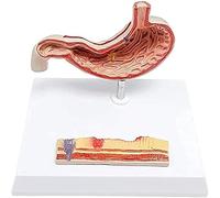 Modèle d'anatomie de l'ulcère gastrique, modèle d'anatomie médicale de maladie gastrique, modèles d'anatomie des organes humains pour l'apprentissage et l'enseignement