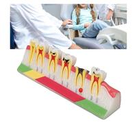 Modèle D'anatomie Dentaire De Carie, Démonstration Anatomique Avec Étiquettes À Code Couleur, Modèle Dents Dentaires For L'étude L'anatomie, L'éducation Médecin-patient Et Soins Bucco-dentaires