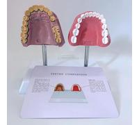 Modèle d'anatomie des dents du système buccal humain, modèle comparatif des dents de fumeur et des dents saines avec une structure anatomique précise et des caractéristiques pathologiques for les étud