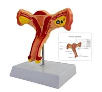 Modèle d'anatomie des organes reproducteurs féminins, modèle d'ovaire de l'utérus pathologique humain, aide pédagogique à la dissection de la maladie de l'ovaire de l'utérus,(Bilateral ovaries)