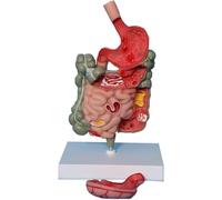 Modèle d'anatomie gastro-intestinale humaine, modèle de pathologie du système digestif amovible avec estomac, gros intestin, rectum, modèle de duodénum, pour l'apprentissage des élèves.