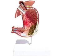 Modèle d'anatomie pathologique humaine de l'estomac, modèle de démonstration du système digestif de gastrite et de lésion gastrique, aide pédagogique médicale for l'affichage clinique et la