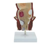 Modèle d'anatomie pathologique rectale humaine, modèle de lésions hémorroïdaires rectales internes et externes, spécimen de sphincter anal du côlon for l'enseignement et la recherche
