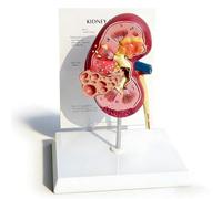 Modèle d'anatomie rénale, modèles normaux Grandeur Nature | Montre les structures rénales saines et pathologiques for la formation des étudiants et la consultation des patients