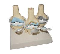 Modèle d'anatomie Squelette, Ensemble de modèles d'articulation du Genou, pathologie arthritique du Genou, Anatomie du Corps Humain, arthrose du Genou, Outil éducatif pour Le Bureau des méde