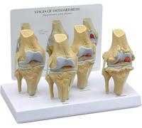 Modèle d'arthrose du Genou, modèle de maladie dégénérative des articulations, modèle d'anatomie pour cabinets médicaux et salles de Classe