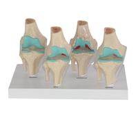 Modèle d'articulation du Genou Humain, Ensemble de répliques anatomiques du Corps Humain, Articulation du Genou arthrosique en 4 étapes for Cabinet médical, Outil pédagogique