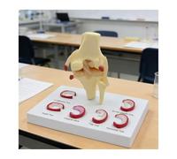 Modèle de blessure au ménisque du Genou Humain avec 6 Types de déchirures, démonstration de réparation du ménisque du Ligament du Genou, for l'enseignement des Sciences médicales