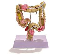 Modèle de côlon grandeur nature 1:1 Outil éducatif de pathologie anatomique pour les cabinets médicaux digestifs et les salles de classe