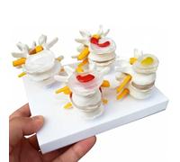 Modèle de colonne lombaire humaine, 4 étapes de pathologie, affichage hernie discale, dégénérescence osseuse et discale, ostéoporose avancée, pour l'éducation médicale