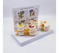 Modèle de Colonne Lombaire Humaine Détachable, Comprend une Base et des Instructions, Modèle de Démonstration de Hernie Discale Intervertébrale 4 Étapes pour Explication en Classe