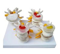 Modèle De Colonne Vertébrale Humaine - Colonne Lombaire Pathologique En 4 Stades Avec Hernie Discale, Dégénérescence Osseuse Et Ostéoporose Avancée. Comprend Une Fiche Descriptive En Anglais.