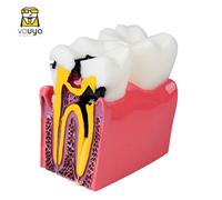 Modèle De Comparaison D'anatomie Pathologique Des Molaires,6 Fois,Pour Faciliter L'étude De La Structure Des Dents Et Du Processus De Lésion - Type 1pcs