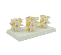 Modèle de Comparaison de la Colonne Lombaire Malade en 4 Étapes Détachable avec Carte d'Instruction en Anglais, Modèle de Colonne Lombaire Humaine pour Explication en Classe