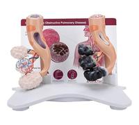 Modèle de comparaison des alvéoles de fumeur et des alvéoles saines, modèle de structure alvéolaire agrandi, avec carte au dos en anglais, for l'enseignement de la santé