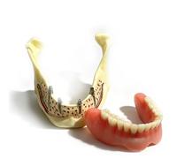 Modèle de décomposition dentaire mandibulaire, modèle anatomique démonstration prothèse dentaire sur implants pour la mâchoire inférieure, destiné à l'enseignement et aux expériences