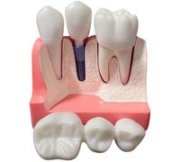 Modèle de dent agrandi 4 fois pour étudiants, modèle d implant dentaire démontable avec couronne et gencive, dents en PVC pour expliquer aux patients, support visuel de formation clinique