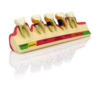 Modèle De Dent De Maladie Parodontale,Enseignement,Étude,Équipement De Dentisterie