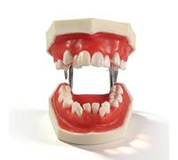 Modèle de Dent D'implant Dentaire,Modèle pédagogique d'orthodontie,démonstration de malocclusion dentaire (typodonte) pratique en cire rouge pour l'enseignement et l'étude des dents