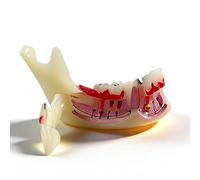 Modèle de dent mandibulaire en décomposition pour l'étude des caries buccales et des kystes radiculaires, outil pédagogique et de démonstration pour les dentistes dent typodont anatomique(1pcs)