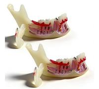 Modèle de dent mandibulaire en décomposition pour l'étude des caries buccales et des kystes radiculaires, outil pédagogique et de démonstration pour les dentistes dent typodont anatomique(2pcs)
