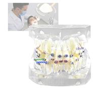 ModèLe De Dent pour Implant Dentaire - MatéRiau : RéSine - Simulation RéAliste - IdéAl pour La Pratique Et l'enseignement