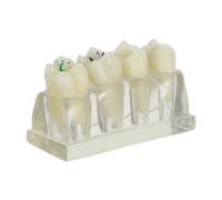 Modèle de Dents Cariées 4 Fois, Anatomie Buccale ABS pour Enseignement | Visualisation Agrandie des Lésions, Usage en entaire, Support Pédagogique Clair pour Praticiens