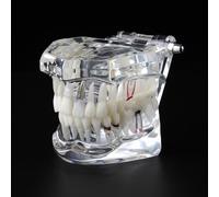 Modèle De Dents De Maladie D'implant Dentaire Pour L'enseignement Médical Science Des Soins De Santé Bucco-Dentaires Étude D'enseignement Des Maladies Dentaires Soins De Santé Bucco-Dentaire