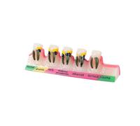 Modèle de dents de maladie parodontale dentaire, étude de modèle de dents typodont enseigne une démo en 5 étapes, pour l'éducation des patients (modèle de parodontite de peau douce)