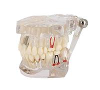 Modèle de dents de maladie transparent, modèle de dents d'implant transparent, modèle de dentiste standard de maladie amovible, modèle d'enseignement pathologique