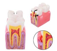 Modele De Dents D'education D'anatomie Dentaire 6 Modeles D'etude De Comparaison De Caries Pour L'etude Et La Recherche De Dentiste