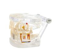 Modèle de dents d'implant amovible 9,5 x 7,9 x 6,9 cm pour dentiste, bureau, enseignement, modèles de cours médicaux pour étudiants, modèle en résine pour l'éducation des patients