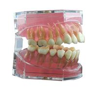 Modèle de dents d'implant dentaire, avec gomme molle et dents en résine amovibles extractibles pour la pratique et l'enseignement