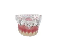 Modèle De Dents D'implant Dentaire,Prothèse Dentaire De Démonstration Avec 4 Implants Maxillaires Supérieurs Et Betérieurs,Modèle Mndibulaire En Acrylique Transparent,1 Pièc - Type 6001 Upper Model