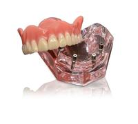 Modèle de dents d'implant dentaire Typodont rose transparent Restauration d'implant dentaire Typodont Prothèse supradentaire 4 implants Démonstration supérieure supérieure pour étude et enseignement