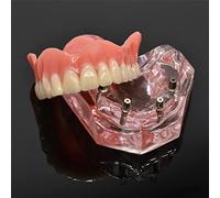 Modèle de dents d'implants dentaires Modèle de restauration dentaire Transparent amovible pour prothèse dentaire pour l'étude de l'enseignement oral dentaire