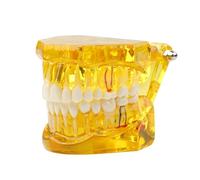 Modèle de dents maladie transparente dentaire d'implant Démonstration d'analyse Dents standard dent d'entraînement typodont avec pont couronne amovible for l'éducation des étudiants (bleu)(Yellow)