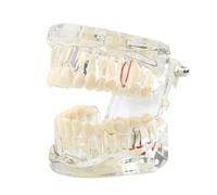 Modèle de dents maladie transparente dentaire d'implant Démonstration d'analyse Dents standard dent d'entraînement typodont avec pont couronne amovible for l'éducation des étudiants (bleu)(Clear)