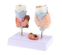Modèle de dissection d'organes normaux et pathologiques de la thyroïde humaine avec base pour étude d'anatomie 17,5 x 12,5 x 18 cm
