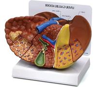 Modèle de foie avec pathologies,Modèle de foie Anatomie du corps humain Réplique du foie avec pathologies pour le bureau du médecin Outil pédagogique