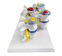 Modèle de hernie discale lombaire anatomique humaine - Modèle de colonne vertébrale humaine - Modèle pour colonne lombaire pour outil pédagogique scolaire (gris)