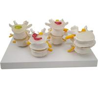 Modèle de hernie discale lombaire Modèle anatomique de la colonne vertébrale lombaire humaine Modèle de lésion du corps vertébral Modèle anatomique de hernie discale lombaire