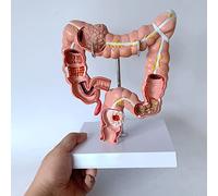 Modèle de lésion colorectale - Anatomie pathologique pour l'enseignement médical et la démonstration des maladies du côlon